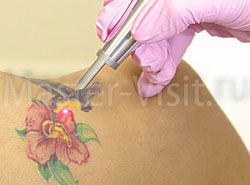 Cum sa reduci (indepartezi) tatuajul - metode, metode, consecinte si ingrijire!