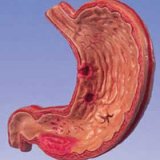 Клініка виразкової хвороби шлунка - ваш доктор айболит