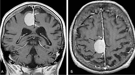 Tratamentul leziunilor oncologice ale sistemului nervos central în clinica neurochirurgicală nipni im.