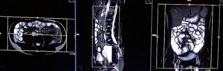 MRI a vékonybél (volvulus leletek kell használni) MRI a vékonybél