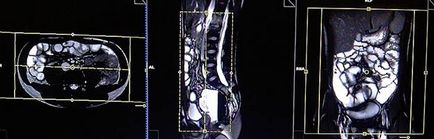 MRI a vékonybél (blokk más repülőgépek) MRI a vékonybél