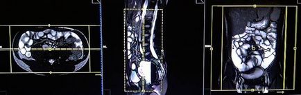 MRI a vékonybél ( „tartsa vissza a lélegzetét belégzés”) MRI a vékonybél