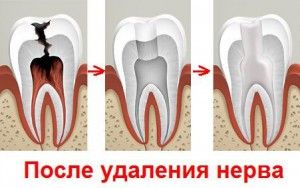 Чи потрібно депульпувати зуби перед протезуванням видаляти нерви