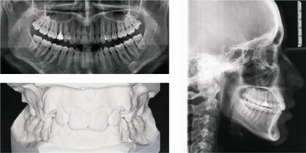 Ортодонтія, виправлення прикусу, вирівнювання зубів - Єкатеринбург, брекети лінгвальні, incognito