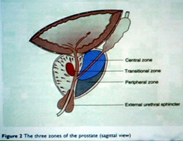 Caracteristici ale diagnosticului de concremente în glanda prostatică