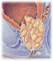 Caracteristici ale diagnosticului de concremente în glanda prostatică