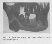 Osteoma, stomatologie terapeutică