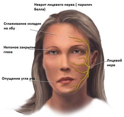 Параліч симптоми і лікування