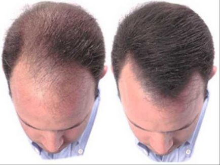 Пересадка волосся на голові у чоловіків відео