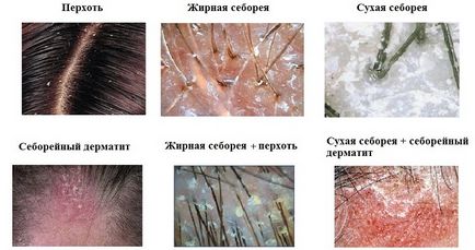 Seborrhoeás dermatitis kezelésére, a tünetek és okai