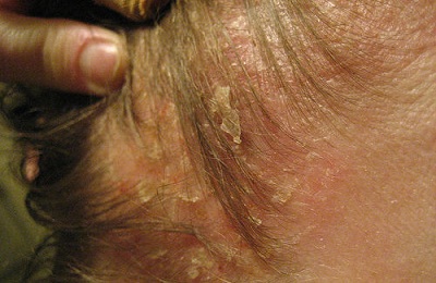 Seborrhoeás dermatitis kezelésére, a tünetek és okai