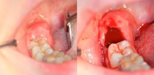 Cât de mult gingiul vindecă după îndepărtarea dintelui înțelepciunii pentru cât timp vindecă gaura