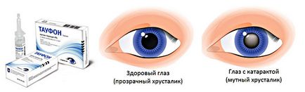 Taufon - picături pentru ochi pentru tratamentul cataractei - instrucțiuni, analogi și recenzii