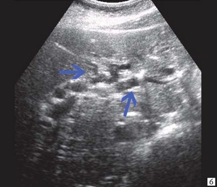 Diagnosticul ultrasonic al icterului mecanic - al lui Kurzantsev