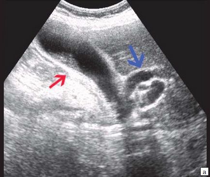 Diagnosticul ultrasonic al icterului mecanic - al lui Kurzantsev