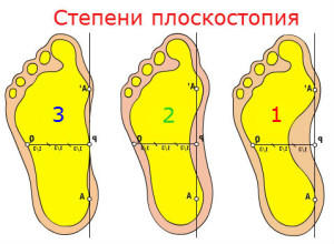 Види плоскостопості причини, симптоми, різновиди, лікування