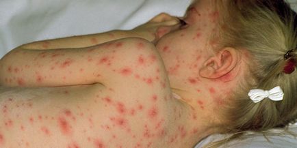 A doua oară varicelă la simptomele copiilor, opțiuni de tratament
