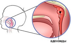 Аденоїди - лікування без операції можливо, відмінне здоров'я!