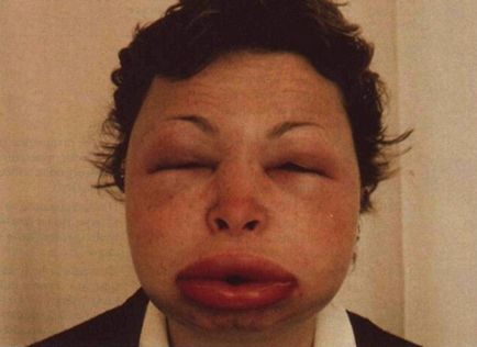 Алергічний набряк обличчя прояви і допомогу