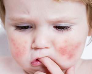 Alergologul a spus, decât dermatita atopică la copii este periculoasă