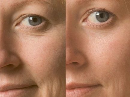 Diamante pentru rectificarea facială, fotografie înainte și după, indicații, contraindicații, video