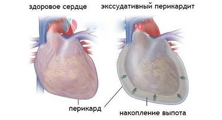 Амілоїдоз серця патогенез, симптоми, діагностика та лікування