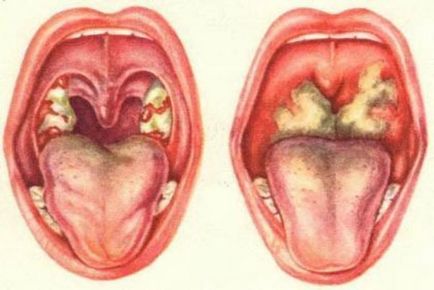 Ангіна Людвіга характерні особливості, збудники, симптоми, фото
