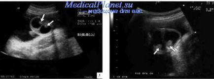 Anomalii ale organelor reproductive masculine ale fătului