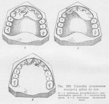 Anomalii ale dinților individuali, stomatologie ortopedică