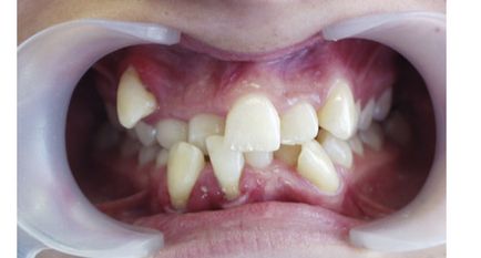 Anomalii cauzate de dinți, metode de tratament