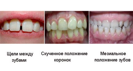 Anomalii cauzate de dinți, metode de tratament