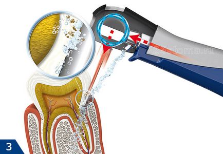 Aparat vector pentru tratamentul reviziilor parodontitei, stomatologie