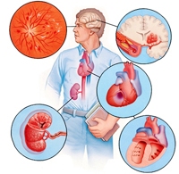 Артеріальна гіпертензія - причини, симптоми, діагностика та лікування
