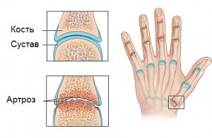 Osteoartrita și boala hepatică