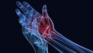 Osteoartrita degetelor și degetelor, simptome și tratament, reabilitare