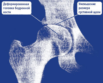 Osteoartrita articulațiilor șoldului