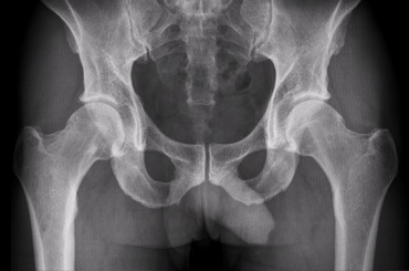 Osteoartrita articulației de șold, centru de osteoporoză