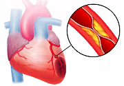 Atherosclerosis kezelés sztatinok (szimvasztatin, fluvasztatin, atorvasztatin)