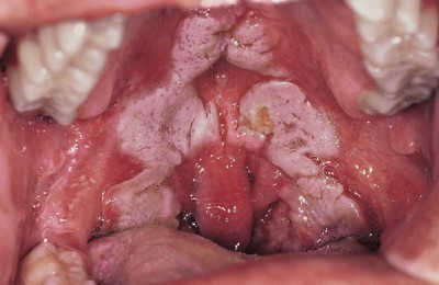 Білий наліт в горлі причини появи, лікування та профілактика