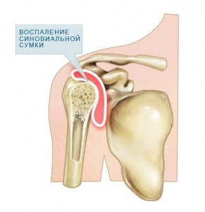 Біль у плечі