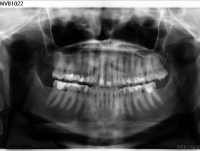 Біль в щоці і щелепи після лікування каналів зубів