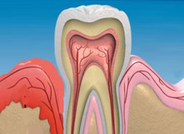 Cum să tratați boala gingiilor după extracția dinților