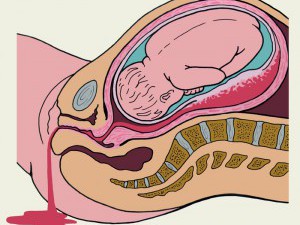 Care este uterul kuvelerei și cauzele acestei patologii