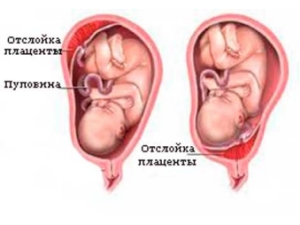 Що таке матка Кувелера, і причини цієї патології