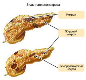 Що таке панкреатит і чим він небезпечний наслідки хвороби