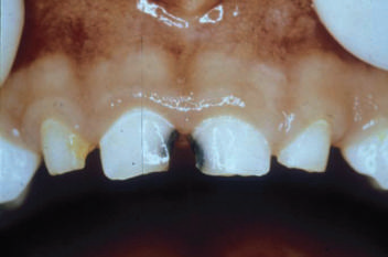 Gyermekek ideiglenes koronák (tejtermékek) fogak