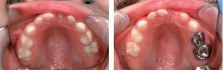 Дитячі коронки для тимчасових (молочних) зубів