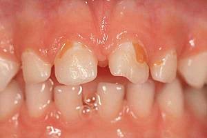 Gyermekek ideiglenes koronák (tejtermékek) fogak
