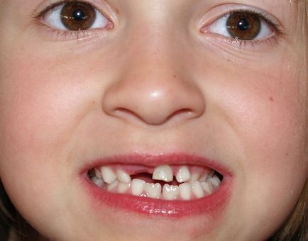 Coroane de copil pentru plusurile și minusurile dinților copilului
