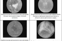 Tratamentul retinopatiei diabetice a bolii, prevenirea, simptomele